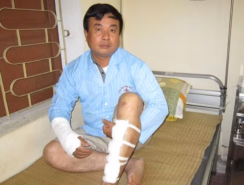 Trước đó, ngày 19/6, anh Cường cũng bị quái xế tông gãy tay và bị thương ở chân. Trước đó, ngày 19/6, anh Cường cũng bị quái xế tông gãy tay và bị thương ở chân.