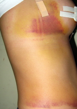 Cả người chị V.T.V bầm tím, đau nhức nhiều ngày sau phẫu thuật nâng ngực Cả người chị V.T.V bầm tím, đau nhức nhiều ngày sau phẫu thuật nâng ngực