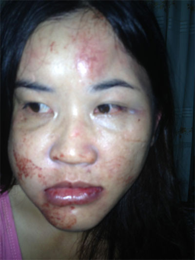 Cô giáo Lan tố bị chồng đánh bầm dập cả mặt