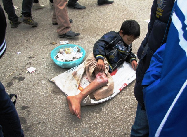 Lộ ra những vết thương để du khách mủi lòng thương và bố thí tiền (Ảnh Lương Kết - Lao động)