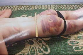 Các vết thương trên người chị Lê Thị Lý, hậu quả của những lần Thịnh bạo hành vợ mình.