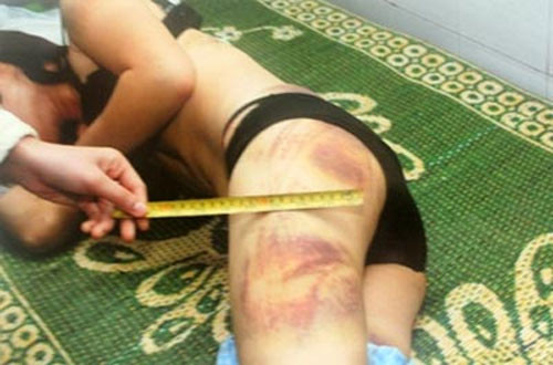 Những vết thương trên người Lê Thị Lý lúc mới nhập viện. Những vết thương trên người Lê Thị Lý lúc mới nhập viện.