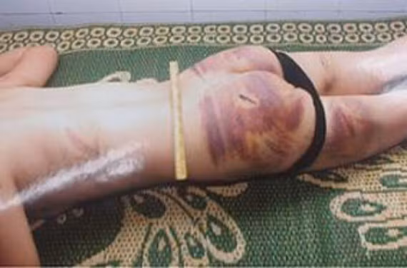 Vết thương trên người Lê Thị Lý Vết thương trên người Lê Thị Lý