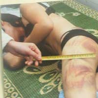 Những vết thương trên người Lê Thị Lý lúc mới nhập viện. Những vết thương trên người Lê Thị Lý lúc mới nhập viện.