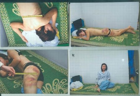 Đánh vợ tới mức bầm dập thế này, người chồng đúng là quỷ dữ (Ảnh: Zing) Đánh vợ tới mức bầm dập thế này, người chồng đúng là quỷ dữ (Ảnh: Zing)