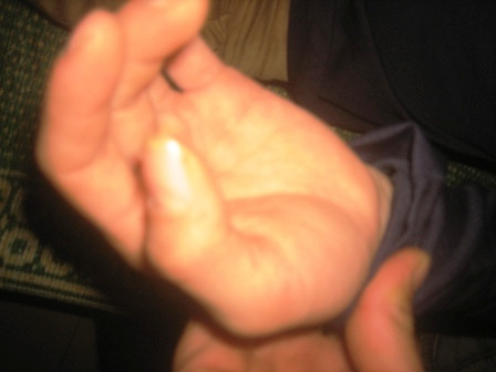 Bàn tay bị dính keo của chị Phương. Bàn tay bị dính keo của chị Phương.