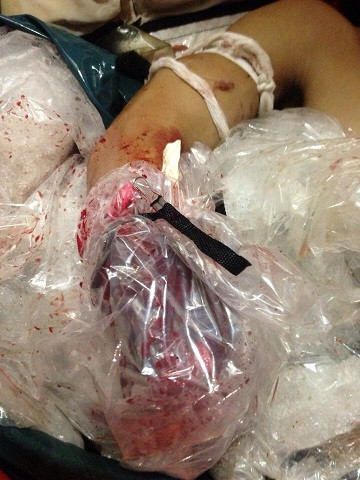 anh Cường trong lúc đánh bắt cá thì bị tai nạn đứt lìa cánh tay và đang được nhân viên y tế tàu SAR 274 cấp cứu. anh Cường trong lúc đánh bắt cá thì bị tai nạn đứt lìa cánh tay và đang được nhân viên y tế tàu SAR 274 cấp cứu.