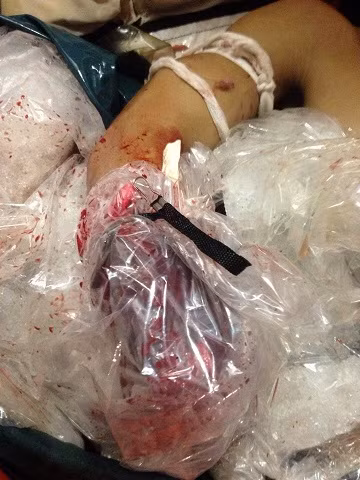 anh Cường trong lúc đánh bắt cá thì bị tai nạn đứt lìa cánh tay và đang được nhân viên y tế tàu SAR 274 cấp cứu.