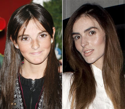 Ali Lohan, em gái Lindsay Lohan bắt đầu sự nghiệp người mẫu từ năm 2011. Hình ảnh hiện tại của cô gái 18 tuổi này trông không có nét gì giống với thiếu nữ xinh tươi, trong sáng vào năm 2005. Ali phủ nhận phẫu thuật thẩm mỹ nhưng các chuyên gia lại đưa ra ý kiến trái ngược. Xem thêm: Điểm danh những chiếc cằm mới của Sao Việt