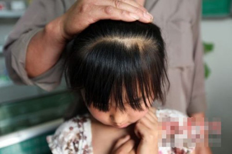 Đô Đô bị giật đứt mất 2 túm tóc khá lớn trên đầu. Đô Đô bị giật đứt mất 2 túm tóc khá lớn trên đầu.