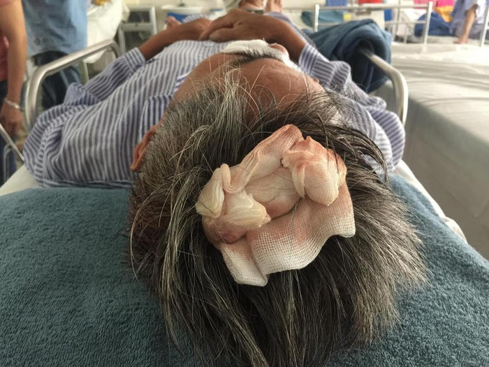 Ông Minh bị khâu 11 mũi ở đầu