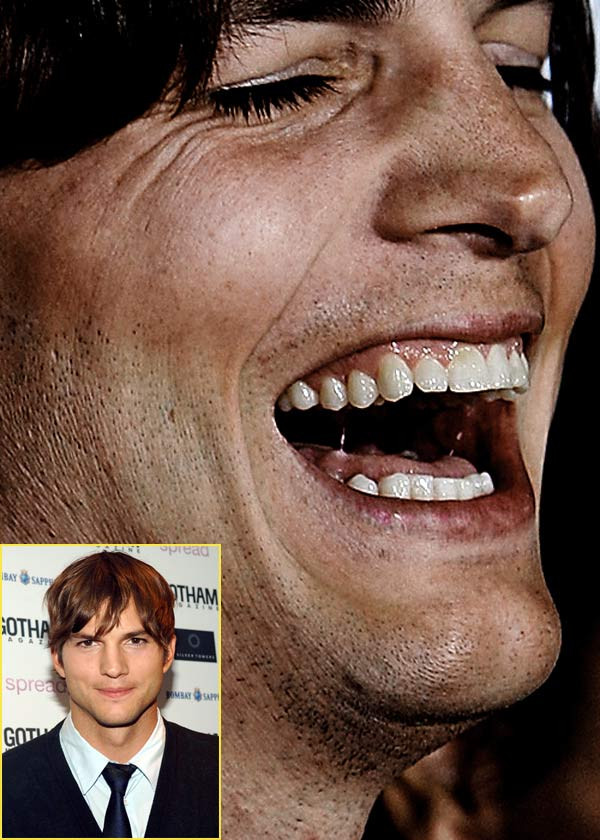 Bạn có còn nghĩ rằng Ashton Kutcher đẹp trai, hoàn hảo? (Ảnh: Xz) Xem thêm: Điểm danh những chiếc cằm mới của Sao Việt / Bộ sưu tập váy xinh chào hè 2012.