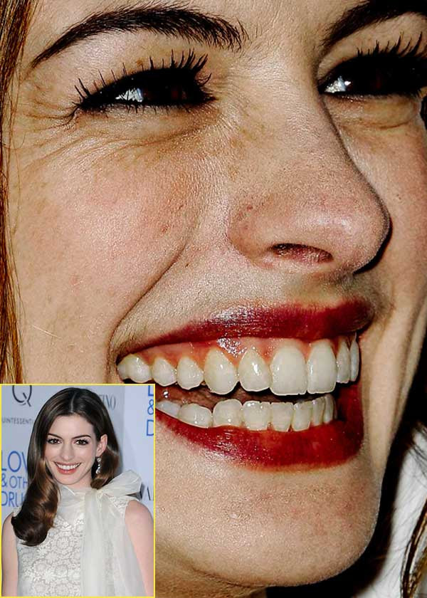 Trong khi đó, "công chúa" Anne Hathaway lại sớm lộ rõ sự già nua. Khóe mắt cô nàng hằn in nhiều dấu chân chim. (Ảnh: Xz) Xem thêm: Điểm danh những chiếc cằm mới của Sao Việt / Bộ sưu tập váy xinh chào hè 2012.