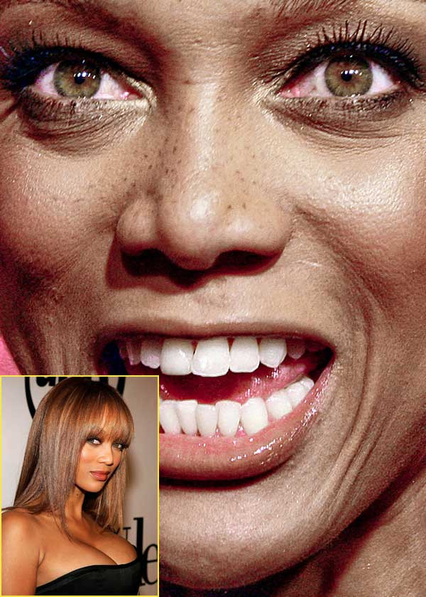 Siêu mẫu Tyra Banks cũng không phải cô gái hoàn hảo. Những đốm tàn nhang nơi sống mũi và hàm răng khấp khểnh là điểm trừ thấy rõ nhất. (Ảnh: Xz) Xem thêm: Điểm danh những chiếc cằm mới của Sao Việt / Bộ sưu tập váy xinh chào hè 2012.