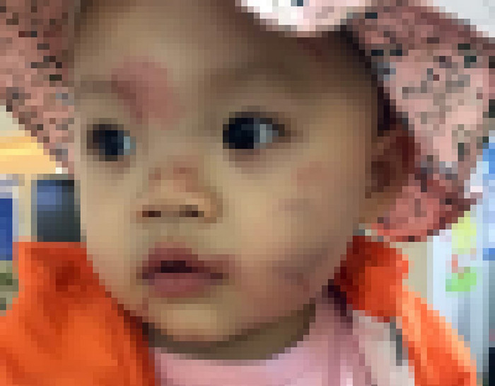 Ủy ban nhân dân huyện An Dương cho rằng, nhưng vết thương trên vùng mặt cháu L.Đ là do bạn cùng lớp cắn (Ảnh: Gia đình cung cấp) Ủy ban nhân dân huyện An Dương cho rằng, nhưng vết thương trên vùng mặt cháu L.Đ là do bạn cùng lớp cắn (Ảnh: Gia đình cung cấp)