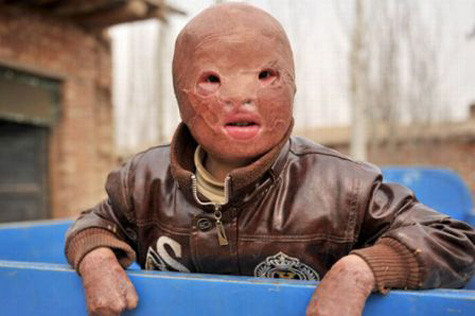 Wang Xiaopeng (Trung Quốc) được biết đến với cái tên cậu bé “không có mặt” bởi vì em không có tóc, môi, mí mắt và ngón chân. Được biết, vụ hỏa hoạn cách đây 2 năm, vào tháng 11/2010 xảy ra khi Wang châm lửa đốt các thân cây ngô đã cướp đi khuôn mặt của em. Wang Xiaopeng (Trung Quốc) được biết đến với cái tên cậu bé “không có mặt” bởi vì em không có tóc, môi, mí mắt và ngón chân. Được biết, vụ hỏa hoạn cách đây 2 năm, vào tháng 11/2010 xảy ra khi Wang châm lửa đốt các thân cây ngô đã cướp đi khuôn mặt của em.