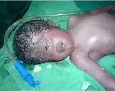 Đứa bé chỉ sở hữu một mắt từ lúc sinh ra Đứa bé chỉ sở hữu một mắt từ lúc sinh ra