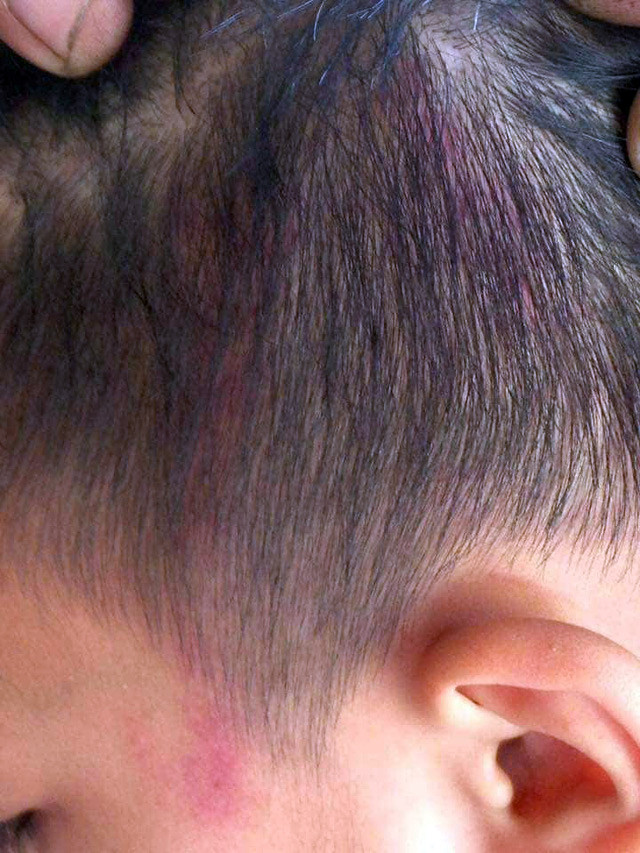 Em Đ. bị Phó hiệu trưởng Trường Trung học cơ sở An Hồng đánh vào đầu (Ảnh:Gia đình cung cấp) Em Đ. bị Phó hiệu trưởng Trường Trung học cơ sở An Hồng đánh vào đầu (Ảnh:Gia đình cung cấp)