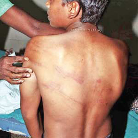 Cậu học sinh 14 tuổi và tấm lưng bầm tím