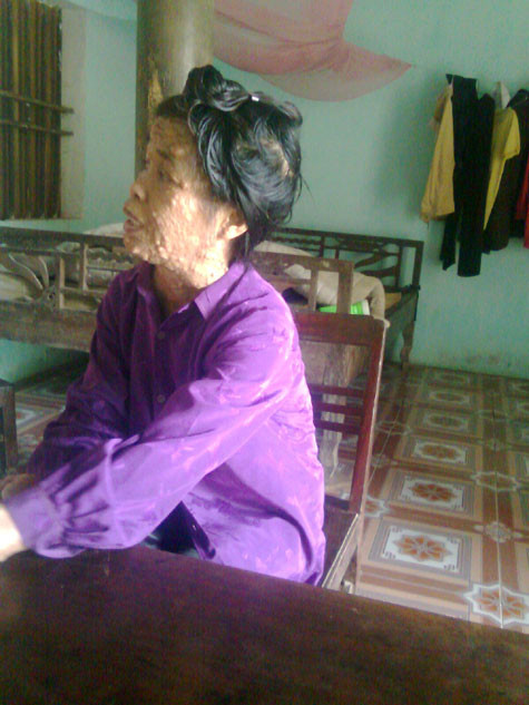 Hơn 50 qua hàng trăm khối ui mọc tràn nan như vậy. Bà rất ái ngại khi giao tiếp với người lạ. Hơn 50 qua hàng trăm khối ui mọc tràn nan như vậy. Bà rất ái ngại khi giao tiếp với người lạ.