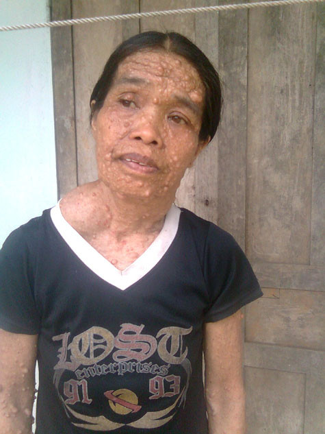 Rất nhiều khối u lớn, bé bủa vây lên cơ thể yếu ớt của bà Rất nhiều khối u lớn, bé bủa vây lên cơ thể yếu ớt của bà