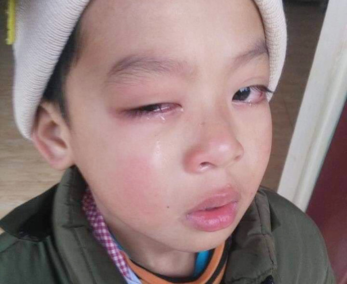 Mắt phải của cháu M. qua 2 lần phẫu thuật, tương lai không nhìn thấy ánh sáng nữa (Ảnh: Gia đình cung cấp) Mắt phải của cháu M. qua 2 lần phẫu thuật, tương lai không nhìn thấy ánh sáng nữa (Ảnh: Gia đình cung cấp)