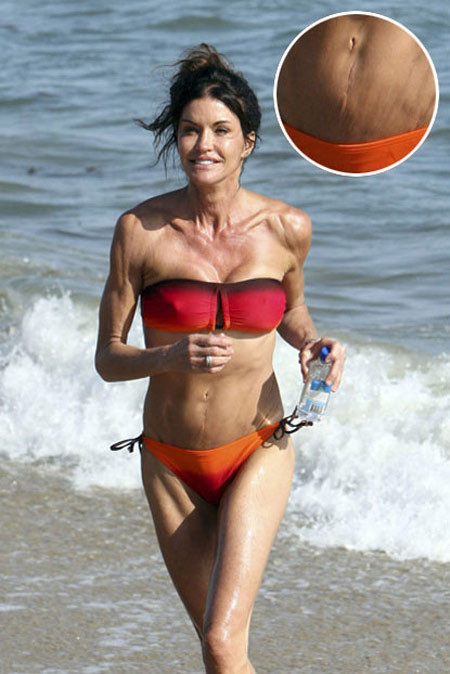 anice Dickinson cũng chẳng thể giấu nổi những vết sẹo ở vùng bụng, dấu vết của những cuộc phẫu thuật thẩm mỹ. Xem thêm: Bằng chứng tố Angela Baby cậy nhờ dao kéo để xinh đẹp. anice Dickinson cũng chẳng thể giấu nổi những vết sẹo ở vùng bụng, dấu vết của những cuộc phẫu thuật thẩm mỹ. Xem thêm: Bằng chứng tố Angela Baby cậy nhờ dao kéo để xinh đẹp.