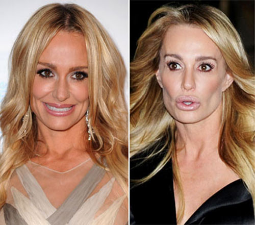 Ngôi sao Real Housewives of Beverly Hills, Taylor Armstrong thừa nhận cô đã bơm môi và từ năm 2010 đến 2012 đôi môi của cô đã dày lên trông thấy. Xem thêm: Sao xấu - Sao đẹp/ Thời trang sao Ngôi sao Real Housewives of Beverly Hills, Taylor Armstrong thừa nhận cô đã bơm môi và từ năm 2010 đến 2012 đôi môi của cô đã dày lên trông thấy. Xem thêm: Sao xấu - Sao đẹp/ Thời trang sao