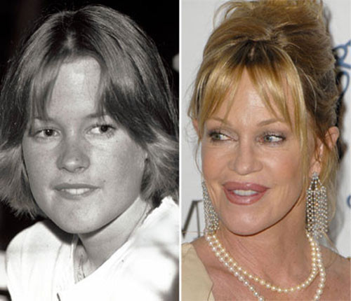 Năm 1976, Melanie Griffith thật ngọt ngào với đôi môi mỏng, khuôn mặt thơ ngây, nhưng bây giờ hình ảnh đó đã chìm vào dĩ vãng. Khuôn mặt ngày càng già nua, nhưng đôi môi của nữ diễn viên lại sưng lên một cách đáng sợ. Xem thêm: Sao xấu - Sao đẹp/ Thời trang sao Năm 1976, Melanie Griffith thật ngọt ngào với đôi môi mỏng, khuôn mặt thơ ngây, nhưng bây giờ hình ảnh đó đã chìm vào dĩ vãng. Khuôn mặt ngày càng già nua, nhưng đôi môi của nữ diễn viên lại sưng lên một cách đáng sợ. Xem thêm: Sao xấu - Sao đẹp/ Thời trang sao
