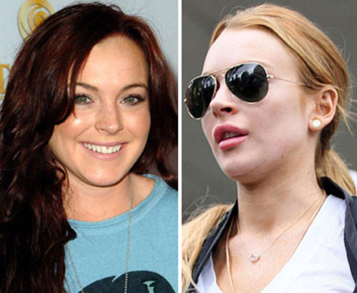 Lindsay Lohan trưng đôi môi dày cộm nhờ bơm Botox vào tháng 10.2010. Xem thêm: Sao xấu - Sao đẹp/ Thời trang sao Lindsay Lohan trưng đôi môi dày cộm nhờ bơm Botox vào tháng 10.2010. Xem thêm: Sao xấu - Sao đẹp/ Thời trang sao