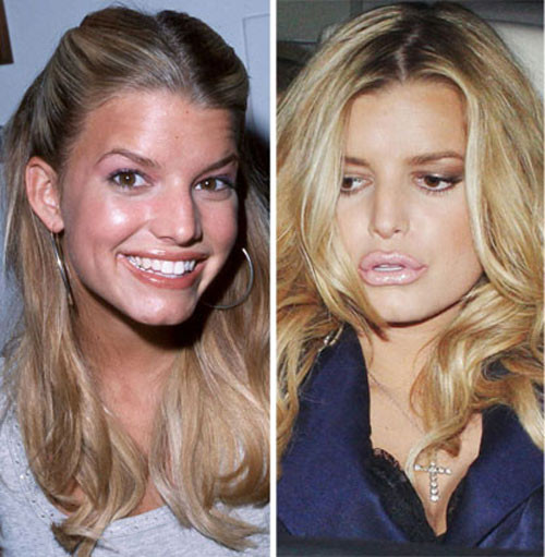 Bức ảnh chụp Jessica Simpson năm 2000 và năm 2008 khác hẳn nhau bởi đôi môi. Xem thêm: Sao xấu - Sao đẹp/ Thời trang sao Bức ảnh chụp Jessica Simpson năm 2000 và năm 2008 khác hẳn nhau bởi đôi môi. Xem thêm: Sao xấu - Sao đẹp/ Thời trang sao