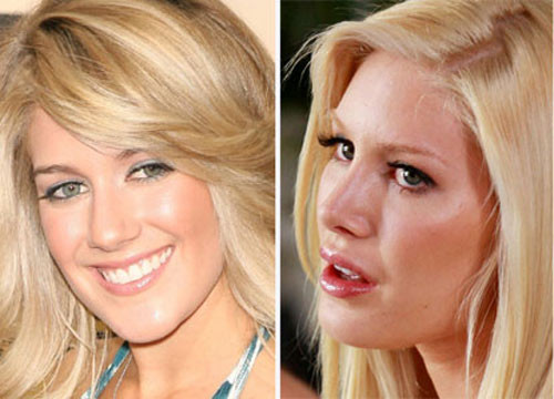Môi chỉ là một trong số vô vàn lần đụng dao kéo của Heidi Montag. Xem thêm: Sao xấu - Sao đẹp/ Thời trang sao Môi chỉ là một trong số vô vàn lần đụng dao kéo của Heidi Montag. Xem thêm: Sao xấu - Sao đẹp/ Thời trang sao