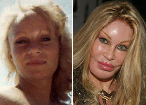 Jocelyn Wildenstein khi còn trẻ trông rất tự nhiên, nhưng khuôn mặt cô bị biến dạng hẳn kể từ khi "nghiện" dao kéo.. Xem thêm: Sao xấu - Sao đẹp/ Thời trang sao Jocelyn Wildenstein khi còn trẻ trông rất tự nhiên, nhưng khuôn mặt cô bị biến dạng hẳn kể từ khi "nghiện" dao kéo.. Xem thêm: Sao xấu - Sao đẹp/ Thời trang sao