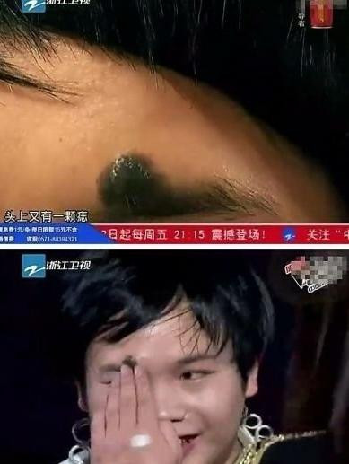 Vương tử đời thứ 11 người Hà Nhì với vết bớt tông truyền của tổ tiên trên lông mày phải, một dấu hiệu của hoàng tộc. Vương tử đời thứ 11 người Hà Nhì với vết bớt tông truyền của tổ tiên trên lông mày phải, một dấu hiệu của hoàng tộc.