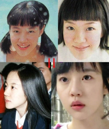 Lim So Jeong của ngày hôm nay có chiếc mũi, đôi mắt và chiếc cằm duyên khác hẳn thời thiếu nữ. Ai tin nổi đây là cùng một người? (Ảnh: tienphong) Xem thên: Sao và những cuộc trùng tu nhan sắc/ Nghệ thuật chăm sóc da tươi sáng, mịn màng. Lim So Jeong của ngày hôm nay có chiếc mũi, đôi mắt và chiếc cằm duyên khác hẳn thời thiếu nữ. Ai tin nổi đây là cùng một người? (Ảnh: tienphong) Xem thên: Sao và những cuộc trùng tu nhan sắc/ Nghệ thuật chăm sóc da tươi sáng, mịn màng.