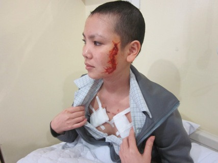 'Quái thú' trên mặt, ngực thiếu nữ nhiễm trùng