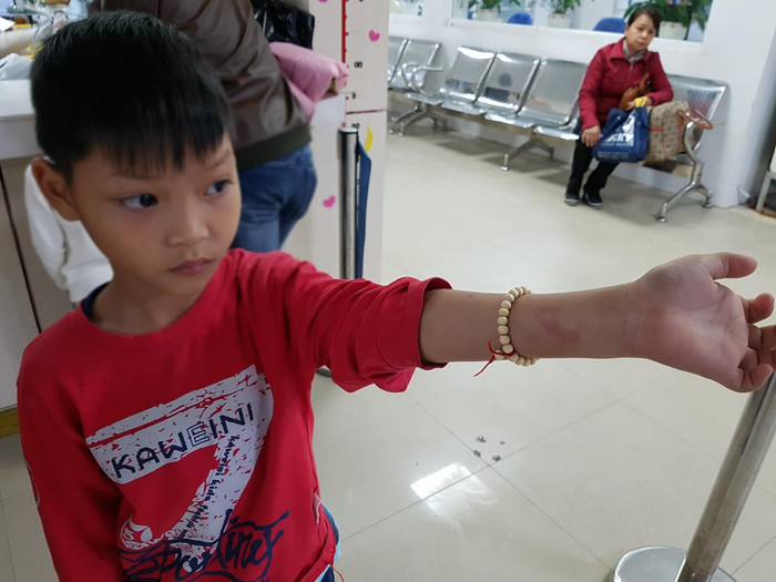 Cháu P. còn bị cô đánh vào tay gây bầm tím (Ảnh: Lã Tiến) Cháu P. còn bị cô đánh vào tay gây bầm tím (Ảnh: Lã Tiến)