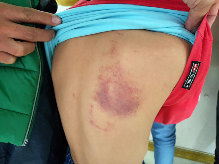 Lưng cháu P bị tím bầm sau khi bị cô chủ nhiệm dùng thước kẻ đánh (Ảnh: Lã Tiến) Lưng cháu P bị tím bầm sau khi bị cô chủ nhiệm dùng thước kẻ đánh (Ảnh: Lã Tiến)