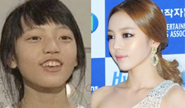 Nữ ca sĩ Goo Hara của nhóm KARA từng sở hữu khuôn miệng hô khi còn nhỏ. Nữ ca sĩ Goo Hara của nhóm KARA từng sở hữu khuôn miệng hô khi còn nhỏ.