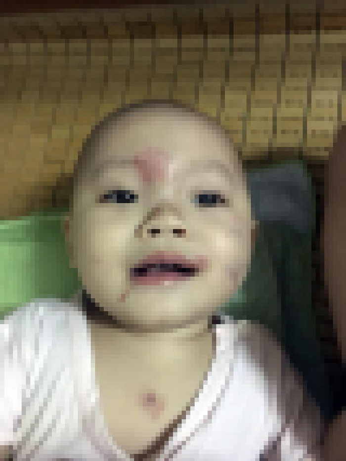 Cháu L.Đ 14 tháng tuổi bị nhiều vết thương trên mặt sau ngày đầu tiên đi học tại trường mầm non tư thục (Ảnh: Gia đình cung cấp) Cháu L.Đ 14 tháng tuổi bị nhiều vết thương trên mặt sau ngày đầu tiên đi học tại trường mầm non tư thục (Ảnh: Gia đình cung cấp)