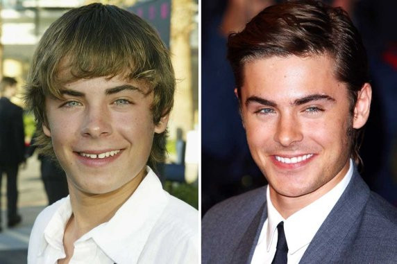 Hình bên trái là nụ cười với hàm răng thưa của anh chàng Zac Efron khi lần đầu đóng chung với Vanessa Hudgen trong “High School Musical”. Ngày đó Zac còn ngây thơ với bộ răng tuổi teen như bao cô cậu mới lớn khác, giờ thì Zac Efron đã hoàn toàn thay đổi từ diện mạo đến ngay cả hàm răng trắng đều.