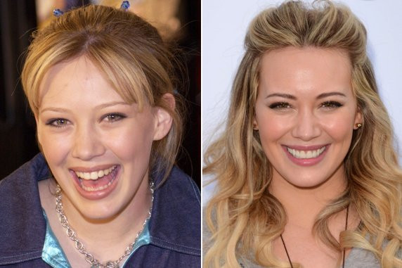 Năm 2005, nữ ca sĩ của tuổi teen Hilary Duff từng đau khổ vì bị gãy mất một chiếc răng trước ngày cưới vài ngày. May mắn là một người trong ban tổ chức lễ cưới của người đẹp quen biết biết một nha sĩ và Duff được đưa đi “cấp cứu răng” khẩn cấp.