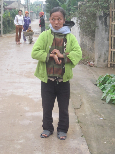 Đôi bàn tay chị bị co dúm lại vì bệnh tật và không có khả năng lao động