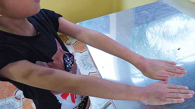 Tay cháu H. bị cô Chiều đánh bầm tím (Ảnh: gia đình cung cấp) Tay cháu H. bị cô Chiều đánh bầm tím (Ảnh: gia đình cung cấp)
