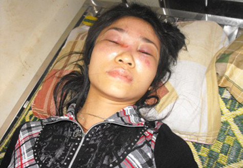 Nạn nhân đang được điều trị tại Bệnh viên Đa khoa huyện Hương Khê Nạn nhân đang được điều trị tại Bệnh viên Đa khoa huyện Hương Khê