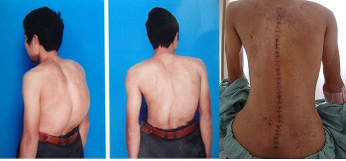 Anh Toàn gù vẹo 85 độ trước mổ và hình ảnh lưng thẳng, cao thêm 10 cm, sau mổ chỉnh gù vẹo 7 ngày