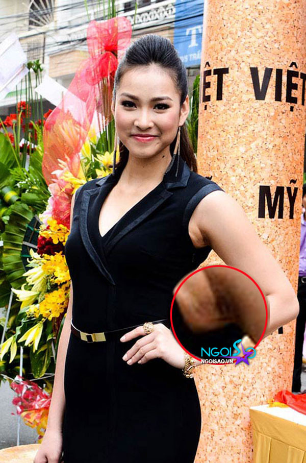 Vương Thu Phương và "vùng cánh" bị thâm, thiếu thẩm mỹ.