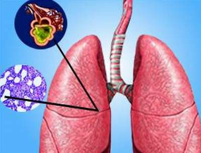 Tổn thương phổi: Khi tâm trạng tức giận, hô hấp sẽ vội vàng, thậm chí xuất hiện hiện tượng hoán đổi khí quá độ. Bao phổi không ngừng khuếch trương, không có thời gian thu co, tức là không có được thư giãn và nghỉ ngơi nên có, từ đó nguy hại đến sức khỏe của phổi. (=>> Xem thêm)