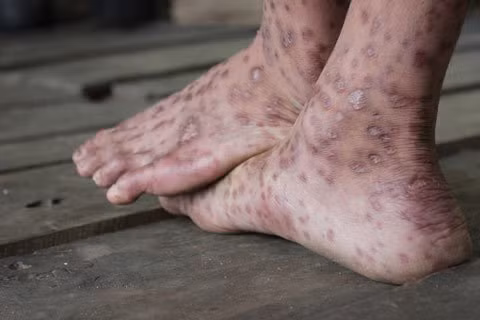 Bộ Y tế nhận định nguyên nhân gây "bệnh lạ", Tin tức trong ngày, nguyen nhan gay benh la, benh la quang ngai, benh la, bo y te, viem da, bao, tin tuc, tin hot, tin hay