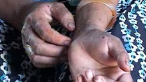 Tổn thương do ghẻ có thể nhầm lẫn với eczema.